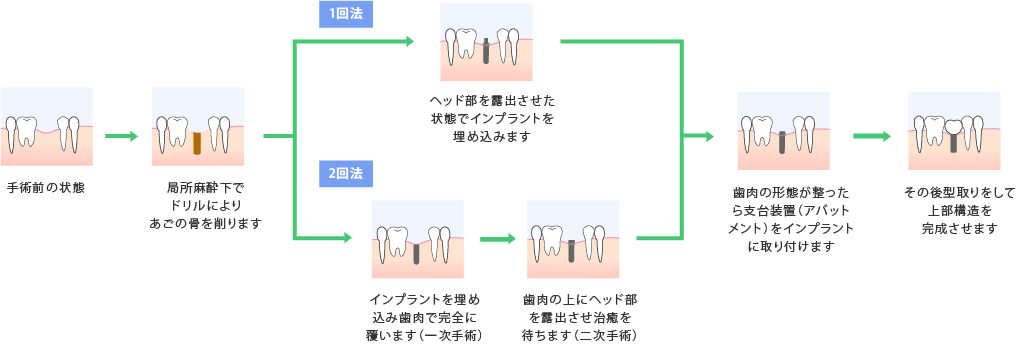 インプラント2回法