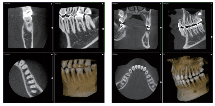 歯科用CTによる精密診査・診断