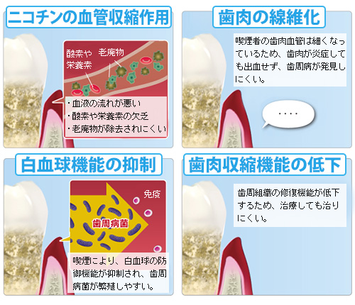 歯周病とタバコの関係